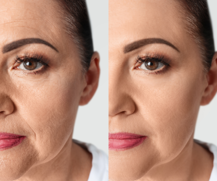 Dermal fillers before and after photos.